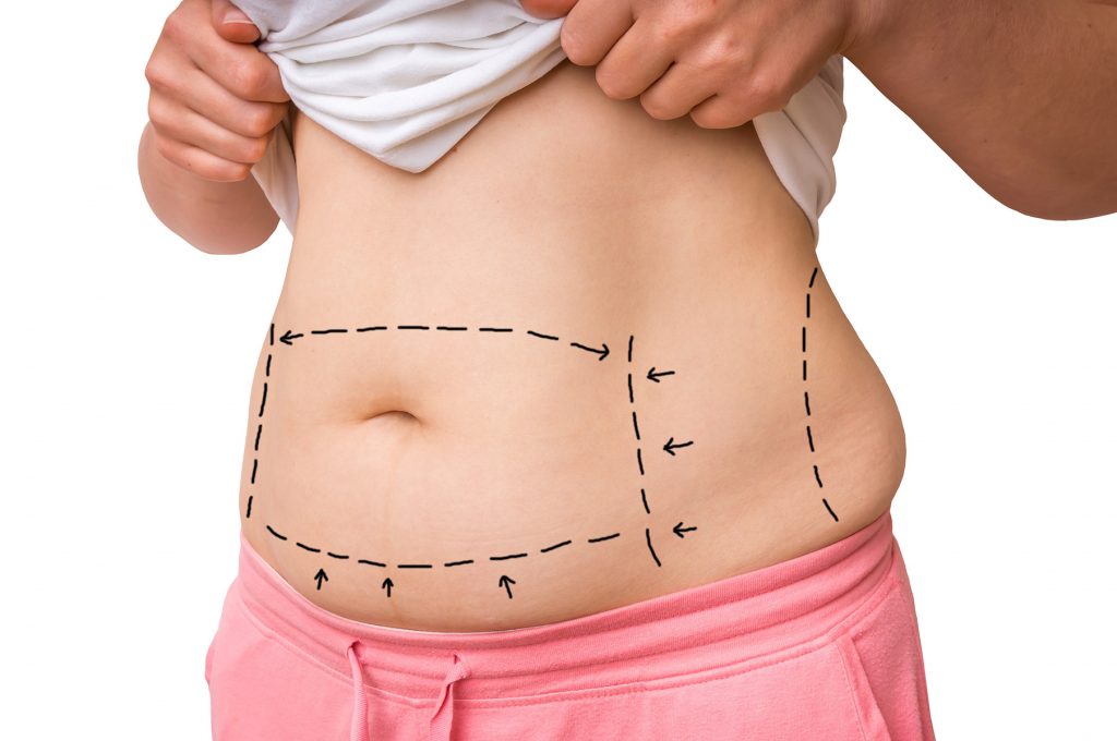 Abdominoplasty