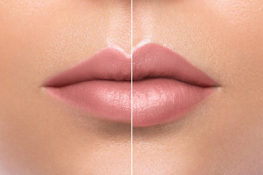 Lip Augmentation