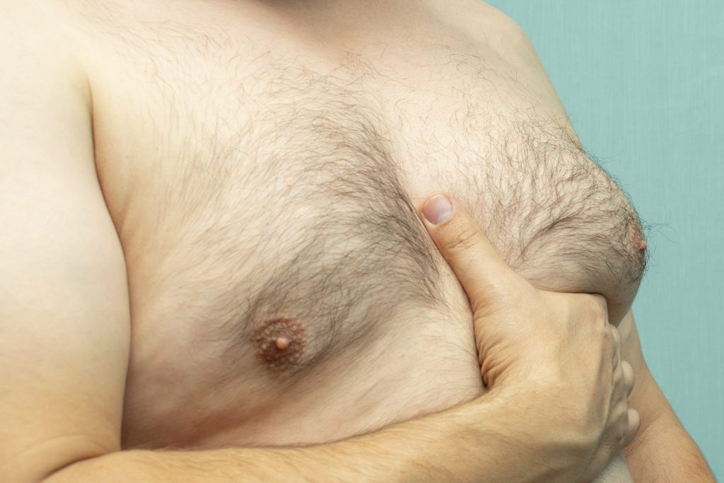 Gynecomastia - Breast Reduction for Men