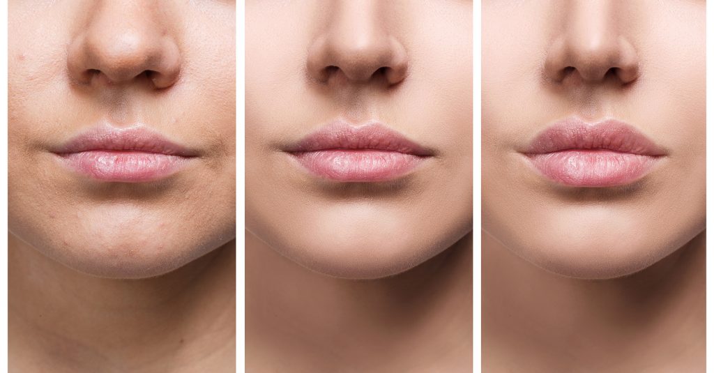 Lips of young woman before and after augmentation