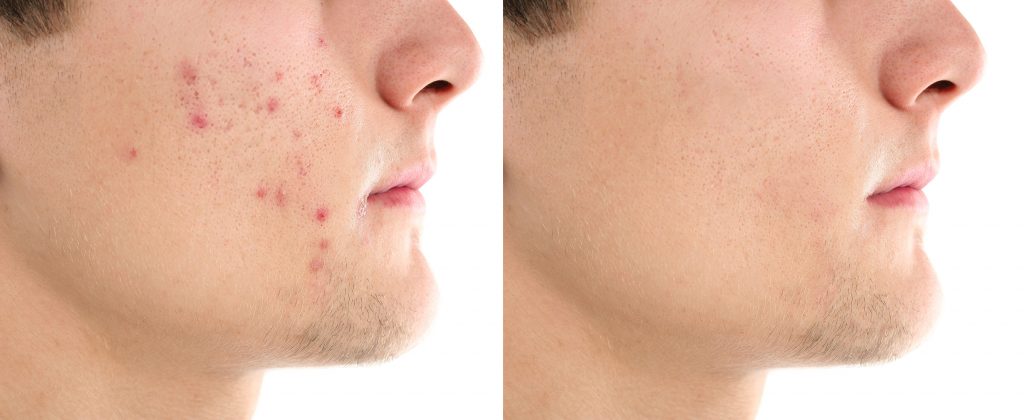 Young Man with Acne